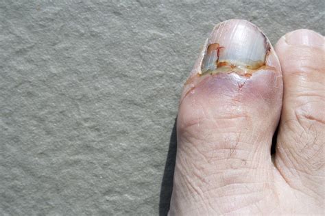 stubbed toe broken nail